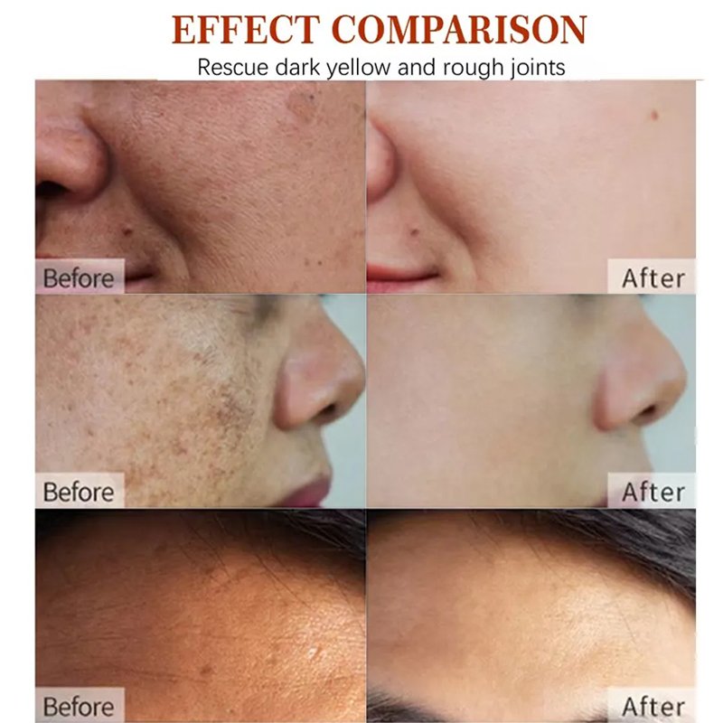 Beauty Skin Care Face Black Freckle Acne Fade Dark Spot Removing Corrector Anti Freckle cream For All Skin Types