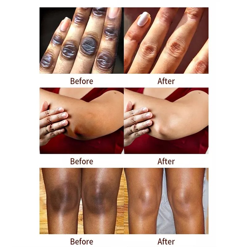 Beauty Skin Care Face Black Freckle Acne Fade Dark Spot Removing Corrector Anti Freckle cream For All Skin Types