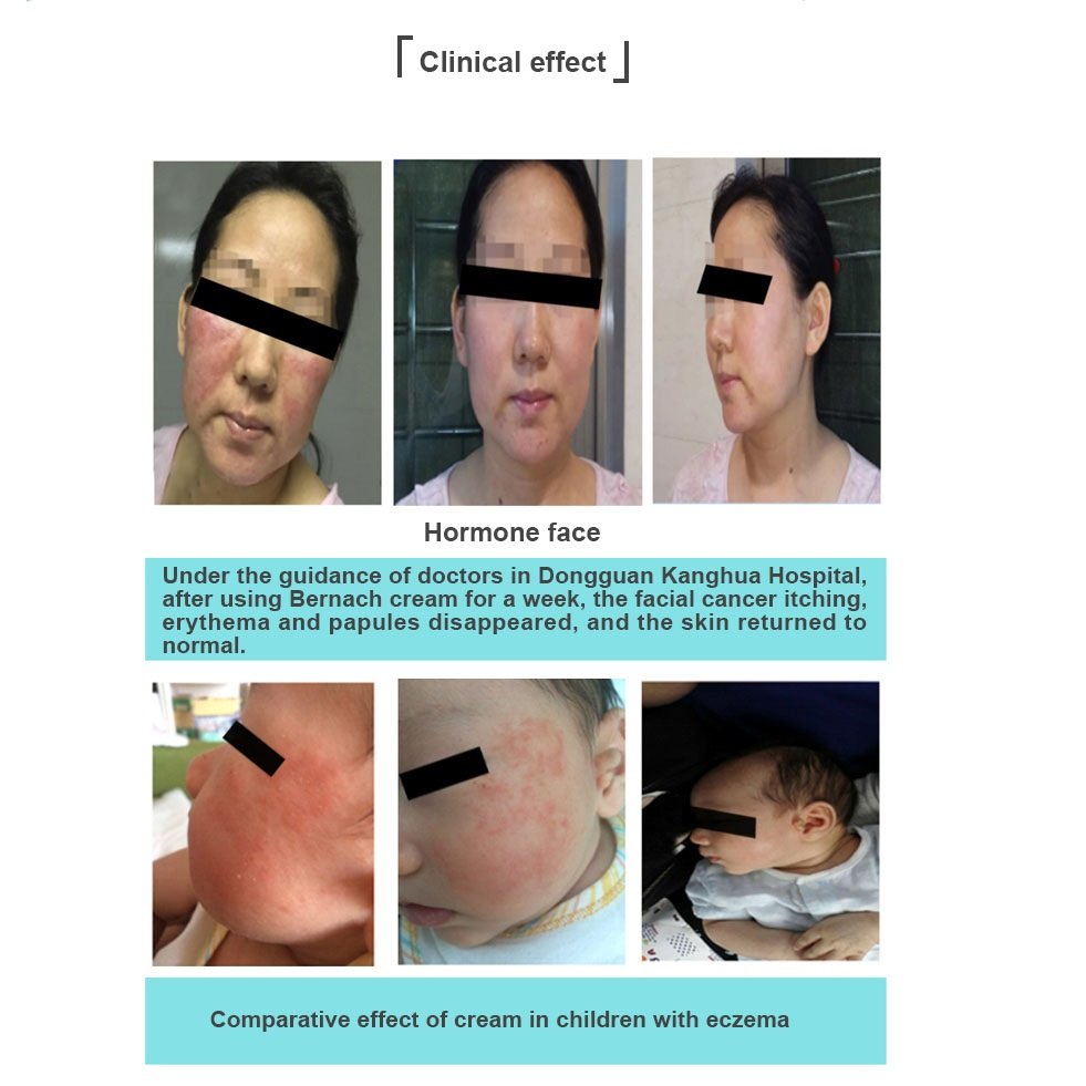 Post Laser Peel Recovery Glow Minimized Pore Recombinant Humanized Type III Collagen Repair Face Cream