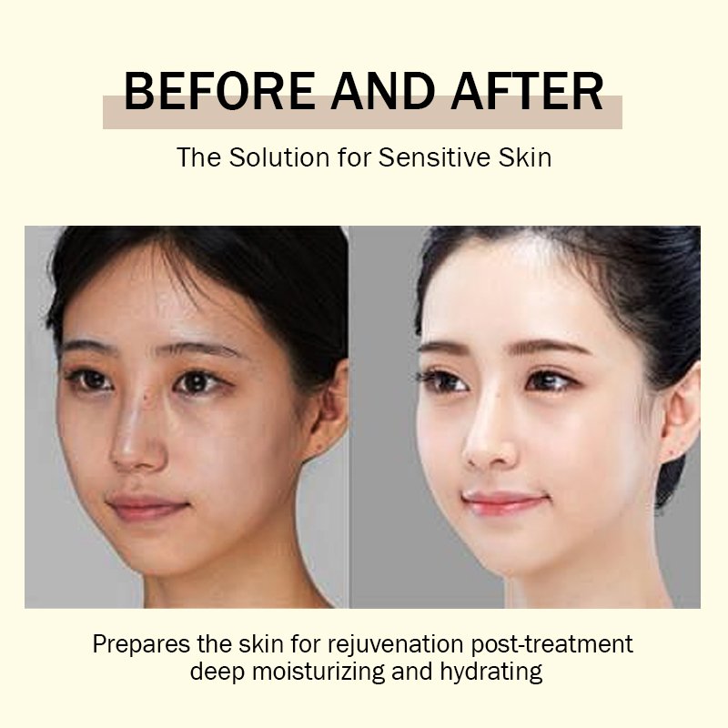 Face Cream Cream for pimples pimple remover Niacinamide Centella Shea Butter Vitamin E Salicylic Acid Carnosine