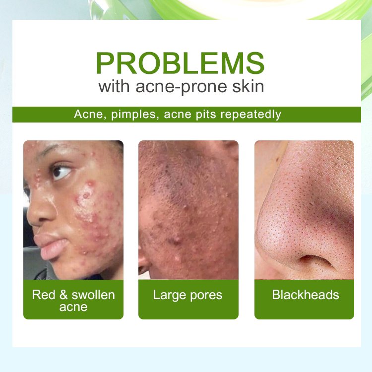 Ailke Acne Breakouts Removal 2 In 1 Reduce Size & Redness Of Breakouts Facial Care Shrink Pores Acne Treatment Face Cream Set