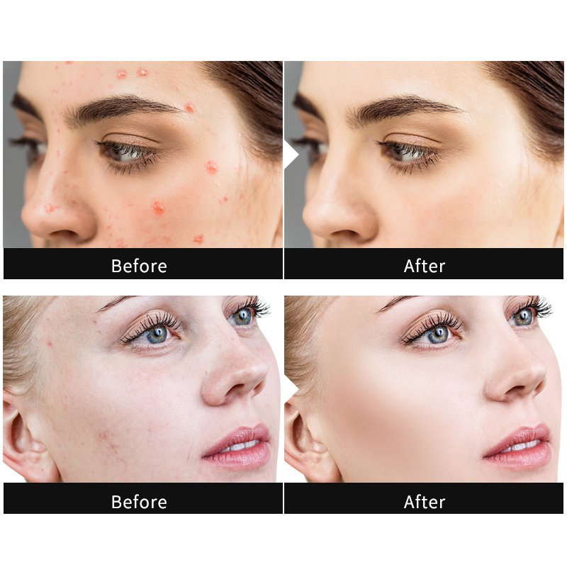 Private Label Best Organic Natural Tea Tree Oil Dark Spot Removal Anti Pimple Repair Scar Treatment acne and pimple Face Cream