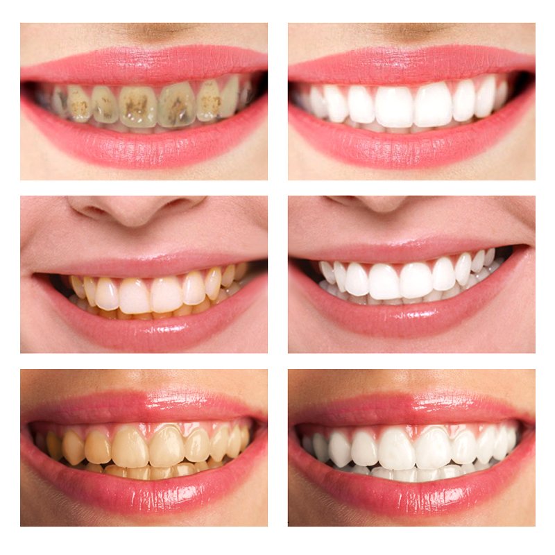 Spring tree Toothpaste Tooth Mousse Cleaning Paste White Private Logo Kit Label Cleansing Teeth Whitening Foam