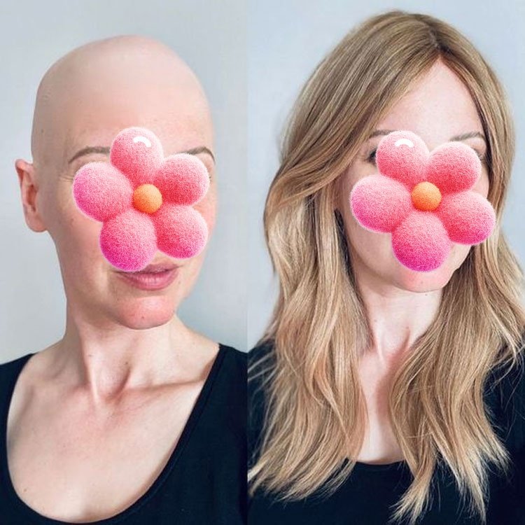 Medical Wig European Human Hair For Alopecia Patients Silicone Silk Top Virgin Hair With Factory Customize Size Full Hand Made