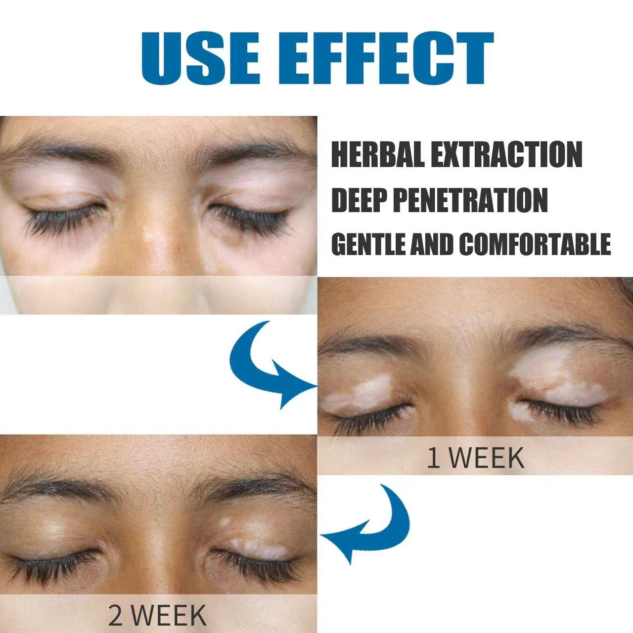 White Spot VitiligoTreament White Spot Skin Repair Psoriasis Localized Vitiligo Ointment Leukoplakia Treatment