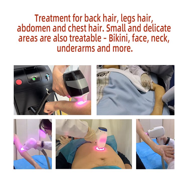 Portable Medical High-Frequency 808 Diode Laser and Pico Laser Machine for Permanent Skin Hair Removal