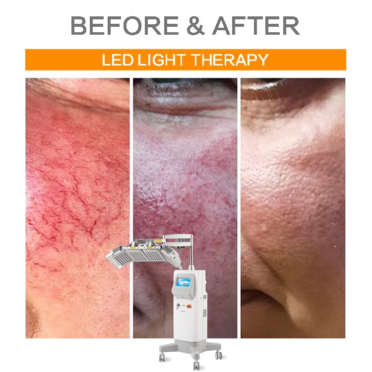 Photon Red Led Pdt Machine Led Light Therapy Photo Dynamic Therapy Green Light Standing Machine for Spa and Salon Whitening Led