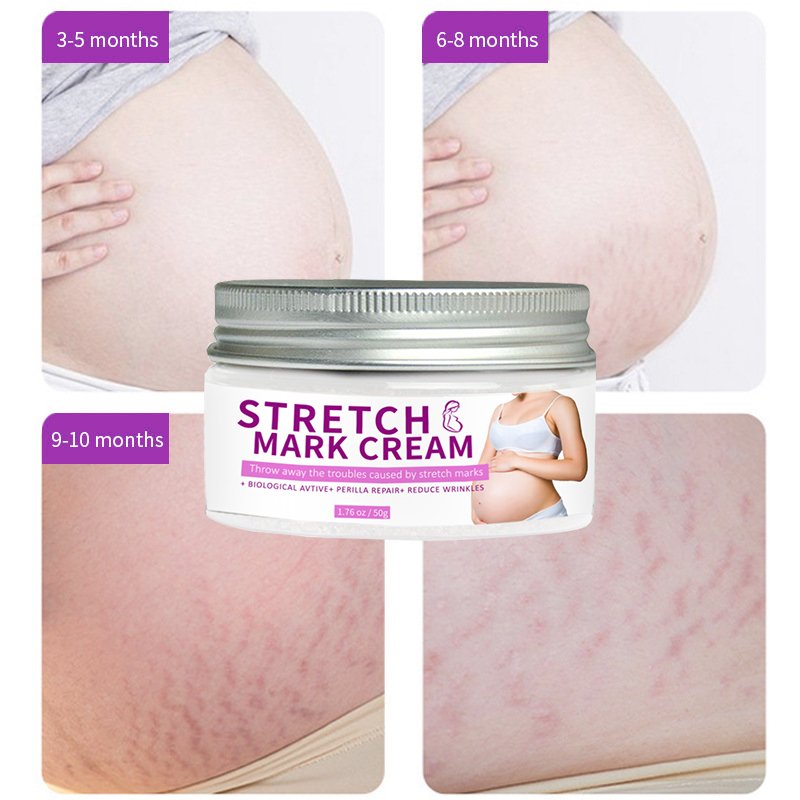 OEM/ODM 50g High Quality Strong Stretch Marks Remover Skin Repair Cream Stretch Mark Scar Pregnancy Stretch Mark Cream