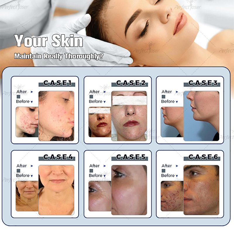 Ce Free Shipping Dermabrasion Hydrogen Dermabrasion Dermabrasion Equipment