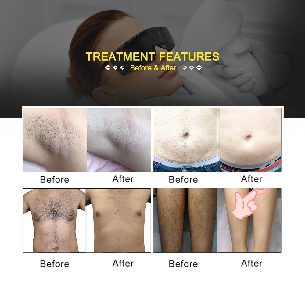 2024 New Arrival Portable Diode Laser Machine for Whole Body Hair Removal 3 Waves 755nm 808nm 1064nm New Laser Beauty Equipment