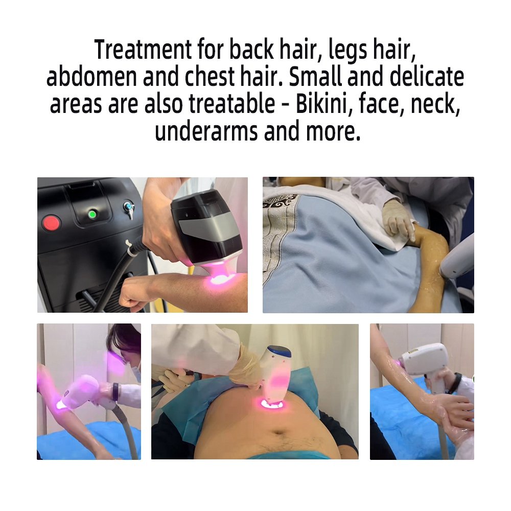 2024 New Arrival Portable Diode Laser Machine for Whole Body Hair Removal 3 Waves 755nm 808nm 1064nm New Laser Beauty Equipment