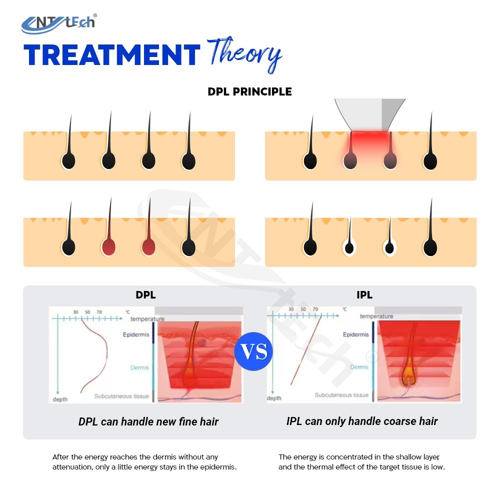 Beauty Equipment 2024 Dpl Laser Diode Laser Triple Wavelength 3 Wave Diode Laser Hair Removal Machine