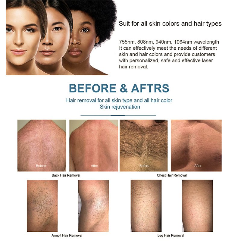 Body and Facial Titanium Diode Laser 808 Machine for Laser Hair Removal Beauty Equipment
