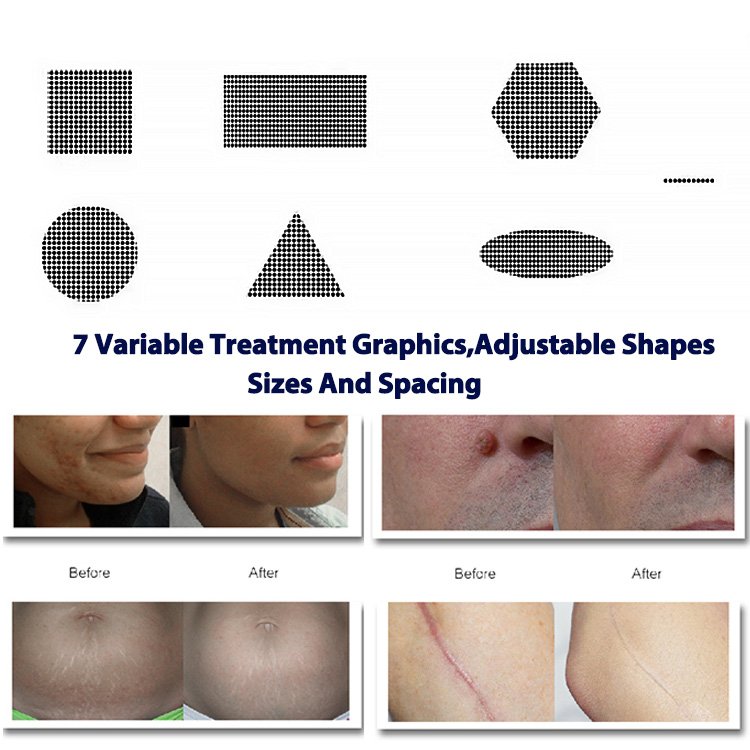 Winkonlaser 10600Nm Wrinkle Remover Vaginal Tightening Pigment Removal CO2 Fractional Laser Cooling Whitening Scar Removal Skin