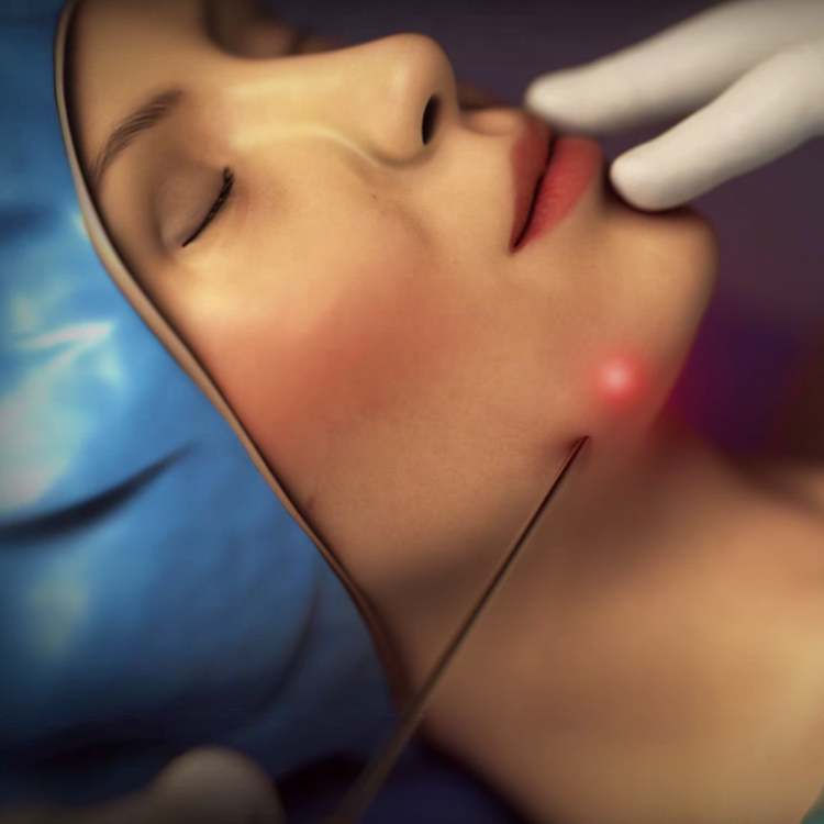 Professional Lipo Laser Lipolysis Equipment Body Shaping Laser Device With CE Triangel 980nm Diode Endo Laser Lift