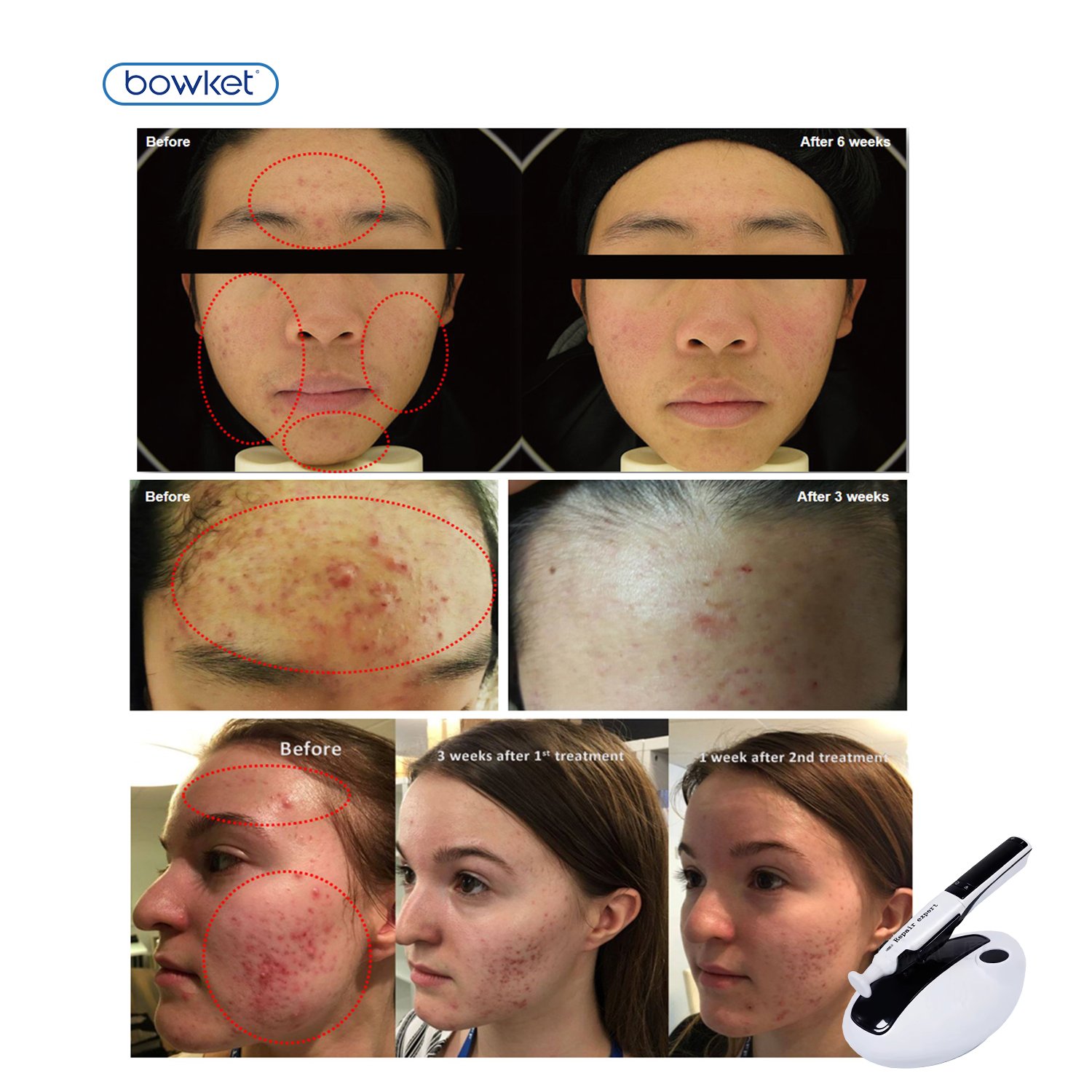 BOWKET Scar Acne Removal and Wrinkle Remover Skin Rejuvenation Device Ozone Plasma Pen Face Lift Tightening US/EU Plugs