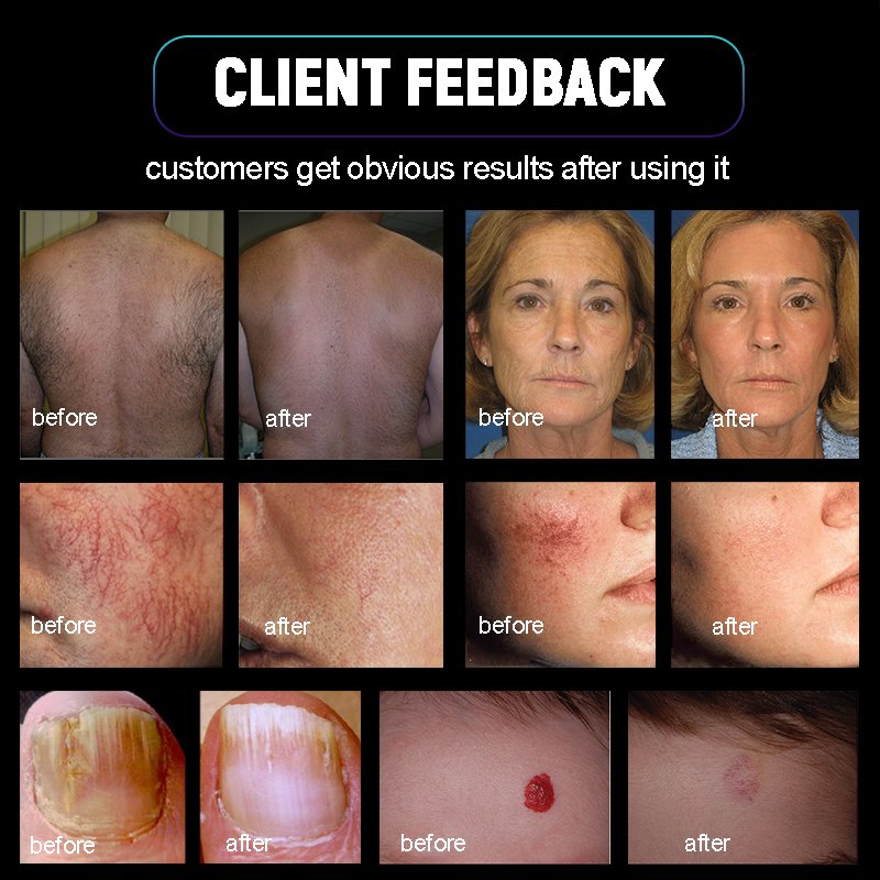 Alexandrite Alex Nd Yag Long Pulse Laser Hair Removal Machine Digital Face Body Epilation UK/US/EU/ZA Includes Skin Rejuvenation