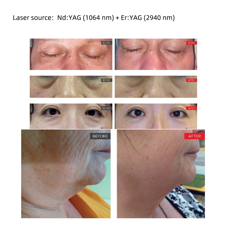 2940nm Erbium Fractional 1064nm Laser Body Rejuvenation Machine Dermatology Equipment for Vaginal Laser Beauty Equipment