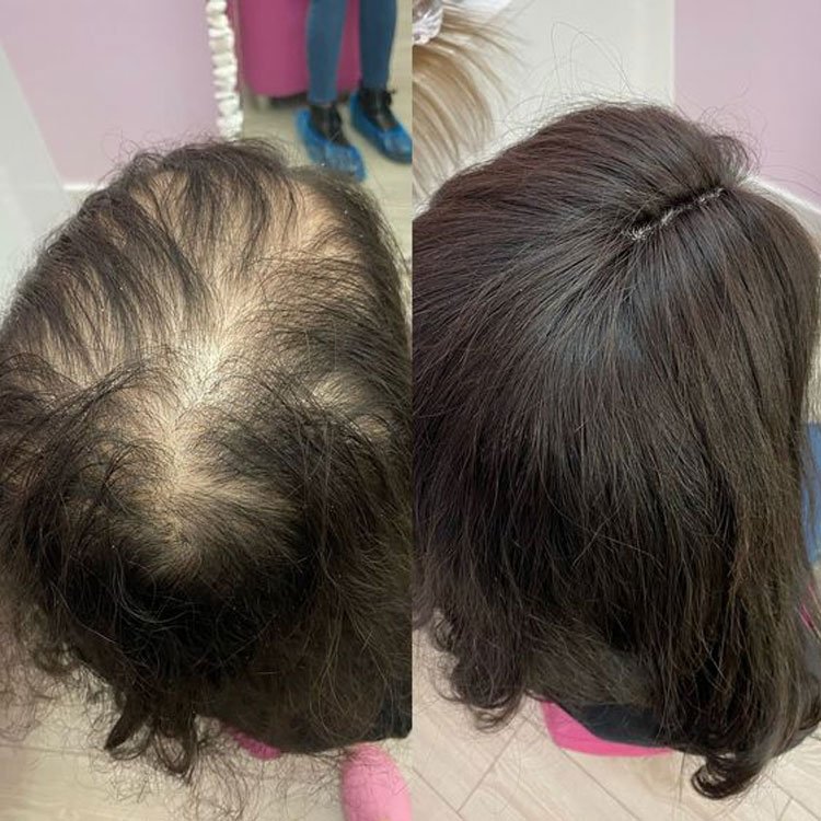 Best quality Factory European 100 human hair Single donor silk top medical wig silicone With swiss lace top glueless for women