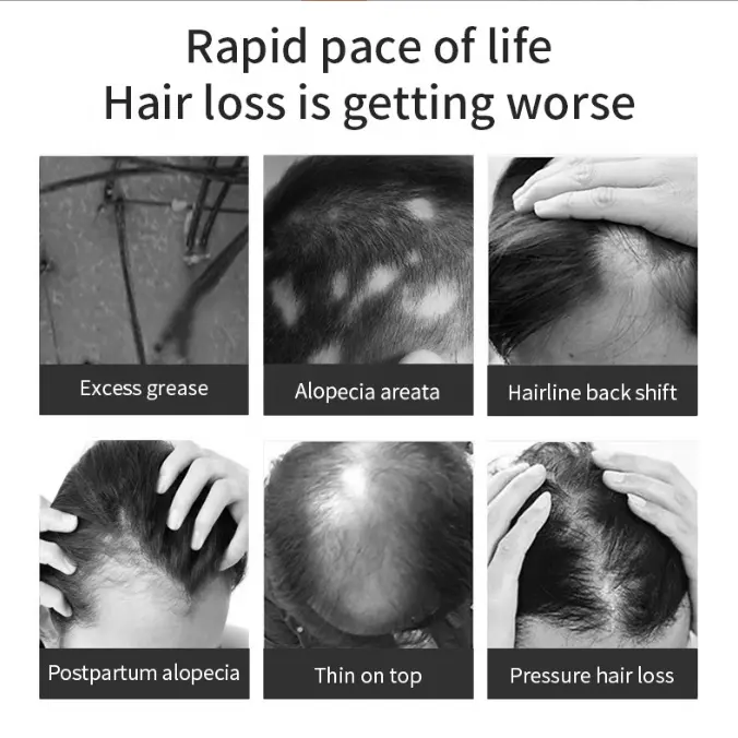 Natural Organic Private Label Anti Hair Loss Treatment Biotin Rosemary Oil Fast Hair Growth Serum Black Women Hair Oil