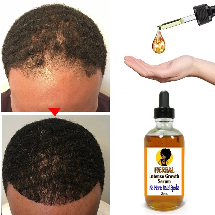 Private Label Black Seed Castor Oil Hair Growth Serum For Thick Hair Fast Growth