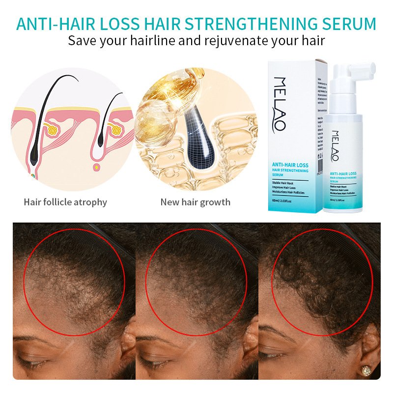 Hair Fast Growth Oil Peppermint Herbal Blend Elixir Anti Hair Loss Treatment Serum Scalp Tonic OEM Effective Hair Growth Serum B