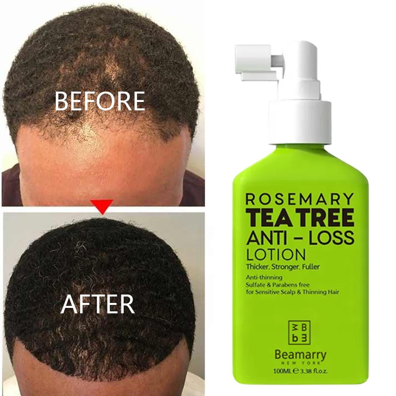 Natural Fast Grow Hair Oil Hair Loss Lotion Care Growth Spray Beauty Hair & Scalp Treatment For Men Women 100ml