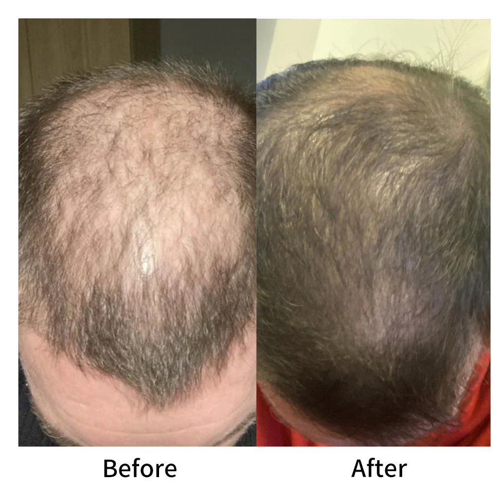 Professional Biotin Keratin shampoo Anti hair loss shampoo and conditioner