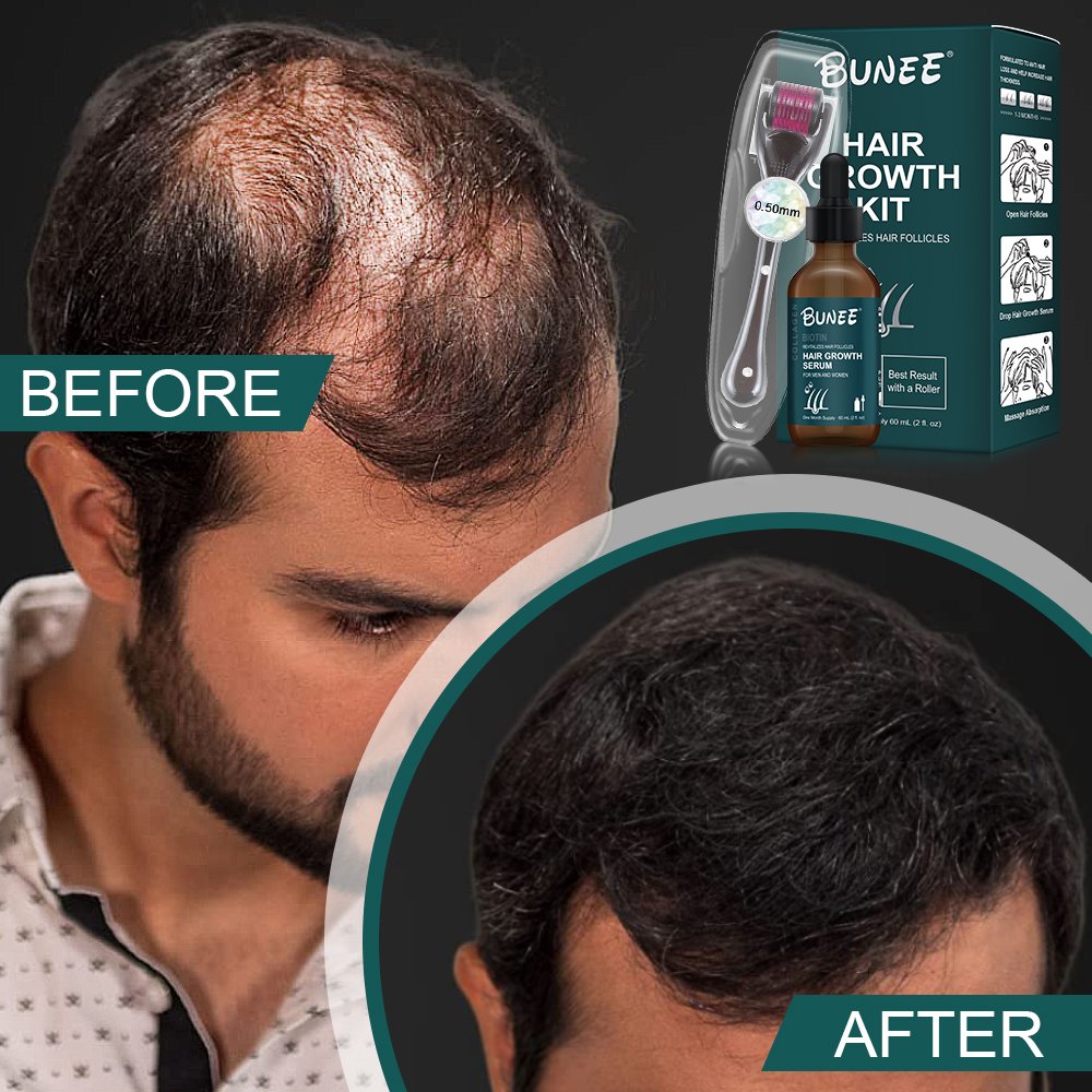 Professional Manufacturer repair hair growth anti loss serum alopeciae treatment hair regrowth tonics kit with low moq