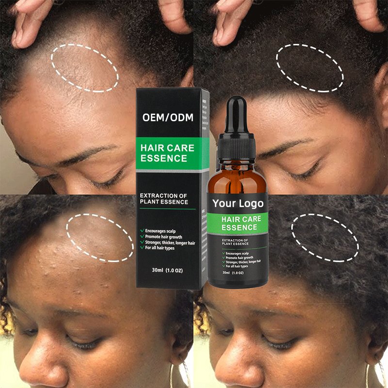 OEM Fast 7days Private Label Organic Natural Ginger Hair Growth Oil Serum Hair Regrowth Tonic
