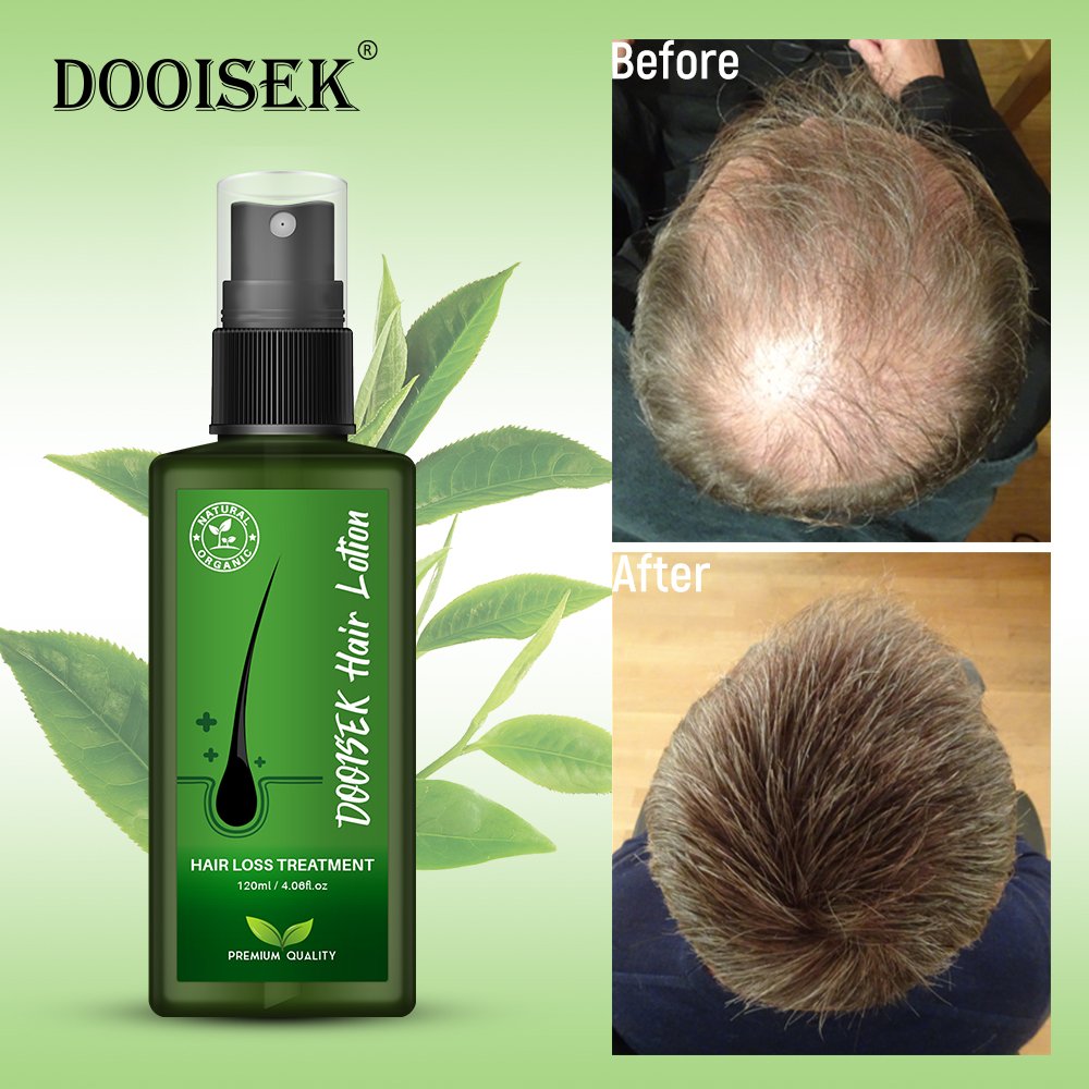 New Arrivals Hair Lotion regrowth serum hair growth essence spray nourish hair roots Genuine Original alopeciae treatment