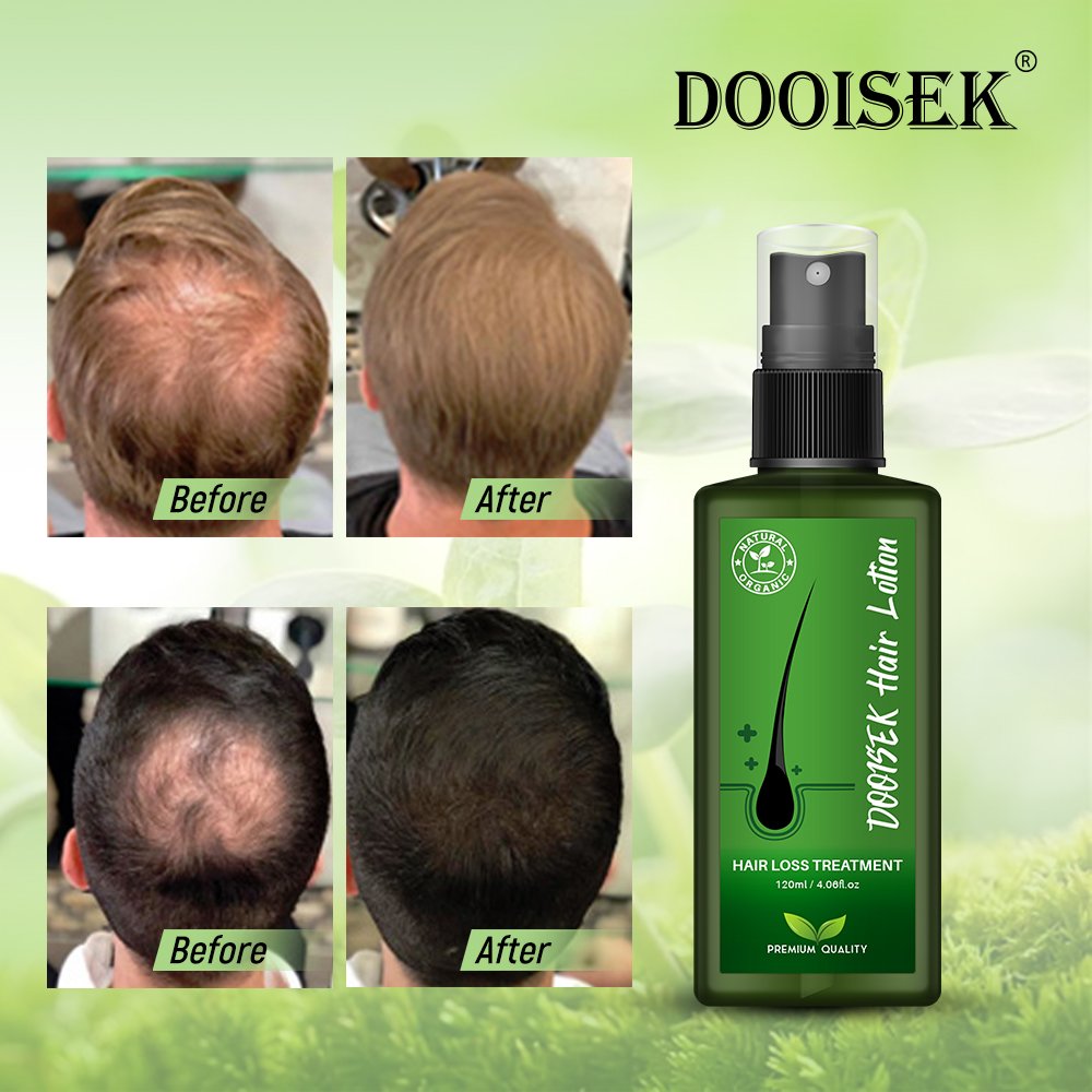 New Arrivals Hair Lotion regrowth serum hair growth essence spray nourish hair roots Genuine Original alopeciae treatment
