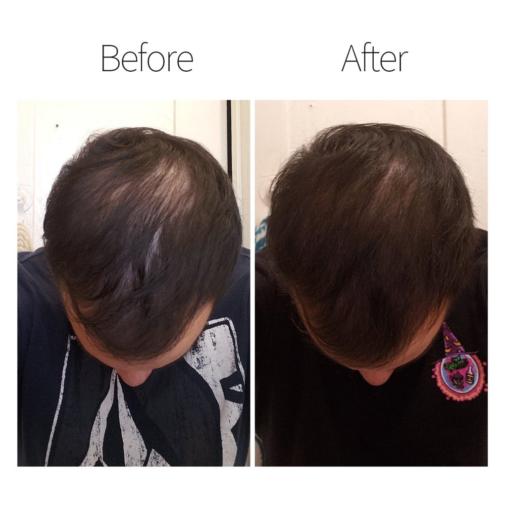 Hair Loss Treatment 60ml One Month Supply Regrowth Product Bio Tonic Anti Alopeciae Serum