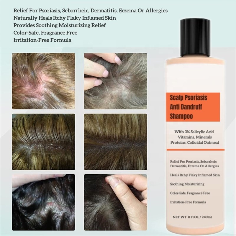 Scalp Psoriasis Dandruff Shampoo Conditioner set Seborrheic Dermatitis Itchy Flaky Inflamed Skin Soothing Moisturizing Relief