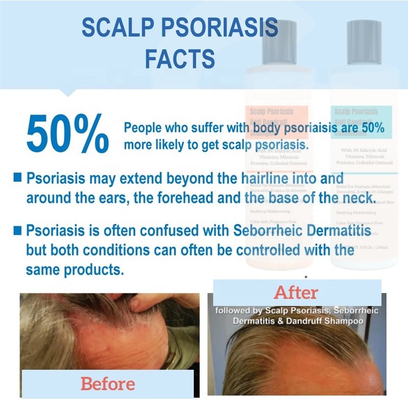 Scalp Psoriasis Dandruff Shampoo Conditioner set Seborrheic Dermatitis Itchy Flaky Inflamed Skin Soothing Moisturizing Relief