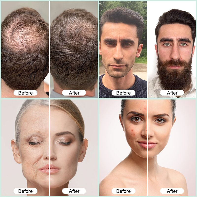 Vegan Stem Cells Peptide Anti Hair Loss 5ml Micro Infusion Hyaluronic Acid Facial Neck Mesotherapy Microneedling Serum For Neck