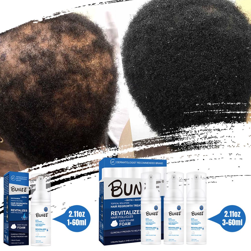 5% Hair Growth Serum Kit Anti-Loss Hair Care Loss Treatment Topical Regrow Foam 60g