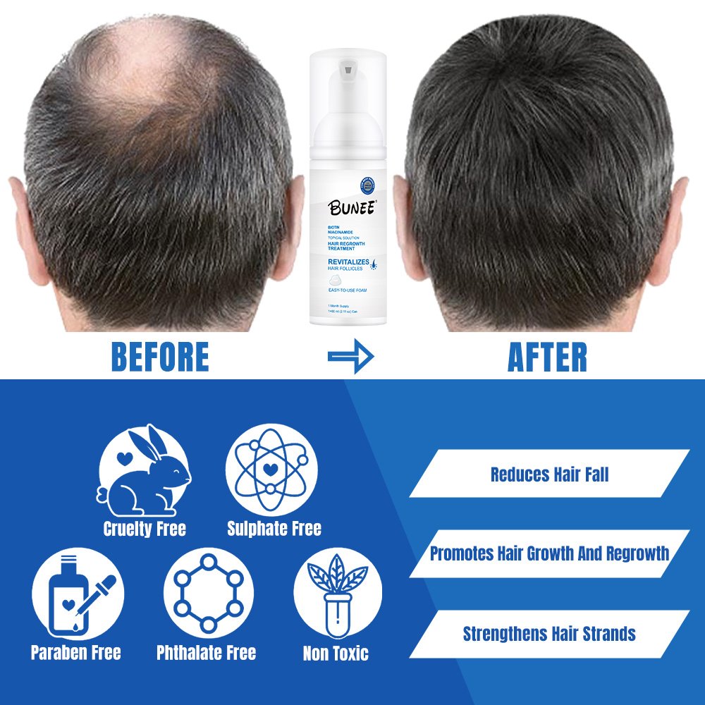 5% Hair Growth Serum Kit Anti-Loss Hair Care Loss Treatment Topical Regrow Foam 60g