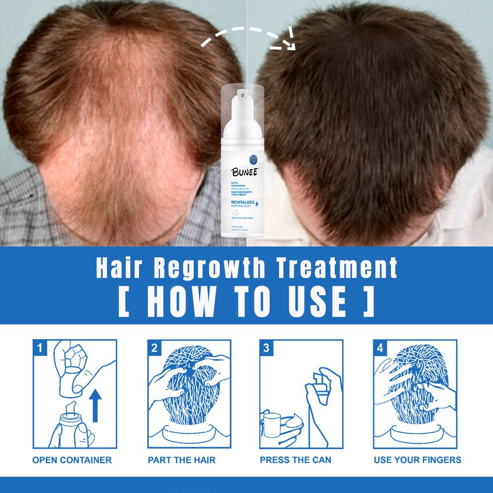 5% Hair Growth Serum Kit Anti-Loss Hair Care Loss Treatment Topical Regrow Foam 60g