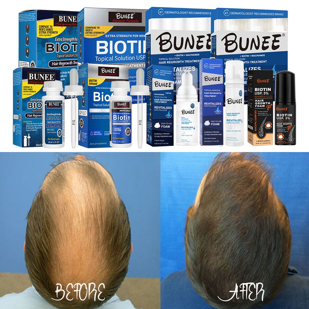 5% Hair Growth Serum Kit Anti-Loss Hair Care Loss Treatment Topical Regrow Foam 60g