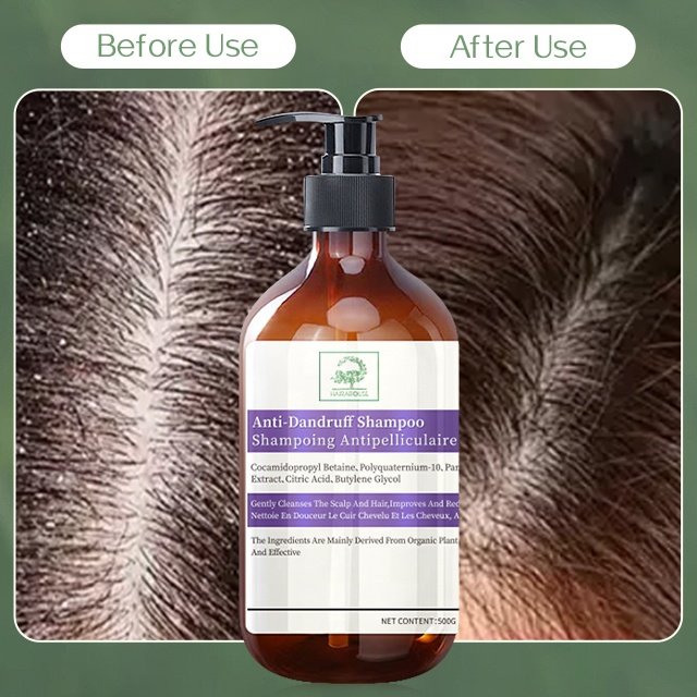 OEM ODM Anti-Dandruff Shampoo For Remove Scalp Buildup Anti-Itch And Dandruff Shampoo