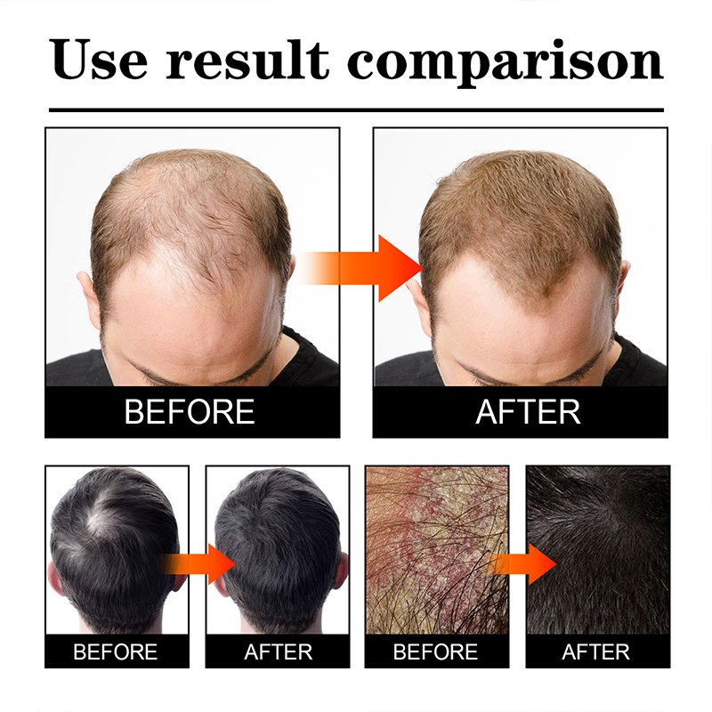 MARIYA Anti hair loss spray hair tonic