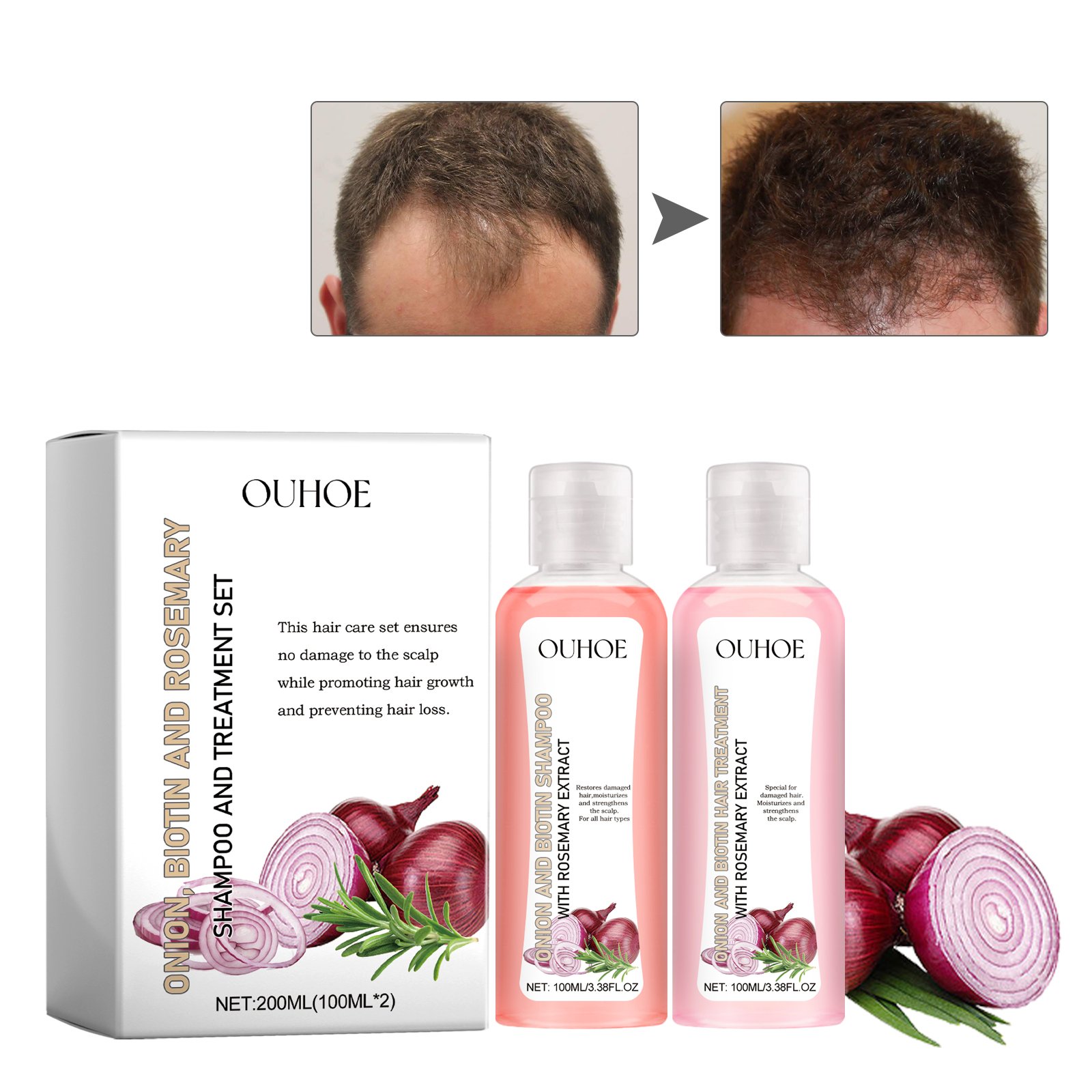 Factory OEM Wholesale Natural Organic Onion Biotin Rosemary Shampoo Treatment For Damaged Repair Stronger Hair Growth Shampoo