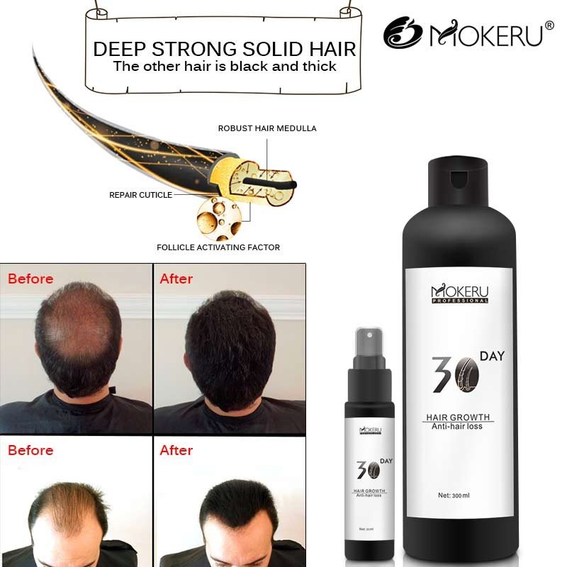 Best hair loss products to help rapid hair growth and prevent fall solution