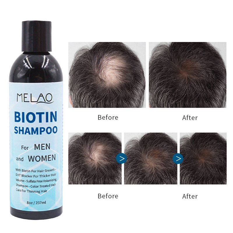 Private Label Thickening Biotin Hairloss Shampoo For Hair Growth Shampoo For Hair Loss All Natural Thinning Hair For Women Men