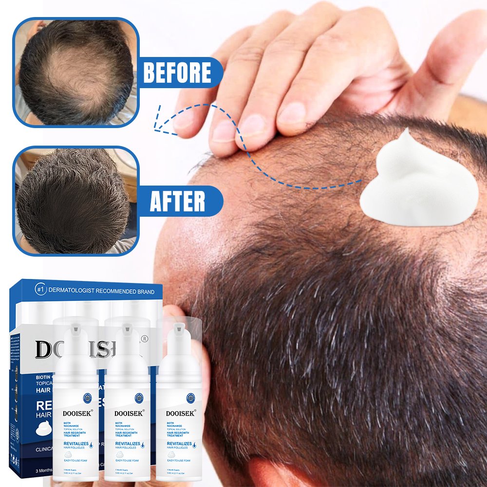 New Trend 60ml Fast Hair Growth Foam Adivasi Tonic 5% Hair Growth foam Rogane Hair Restoration Alopeciae Treatment