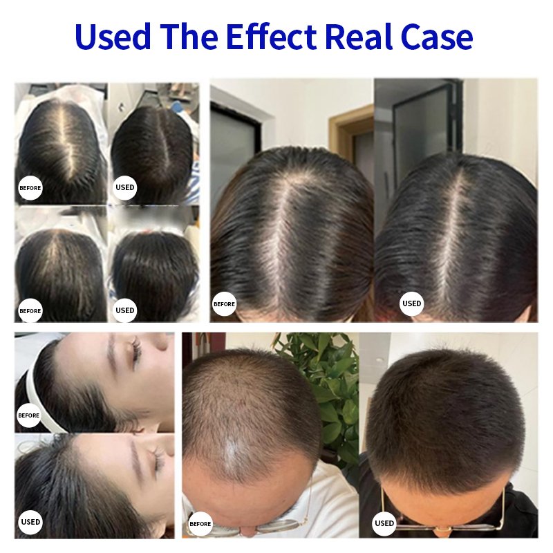 hair meso serum loss fall alopecia and growth treatment regrowth tonics hair grow therapy hair growth microneedling serum