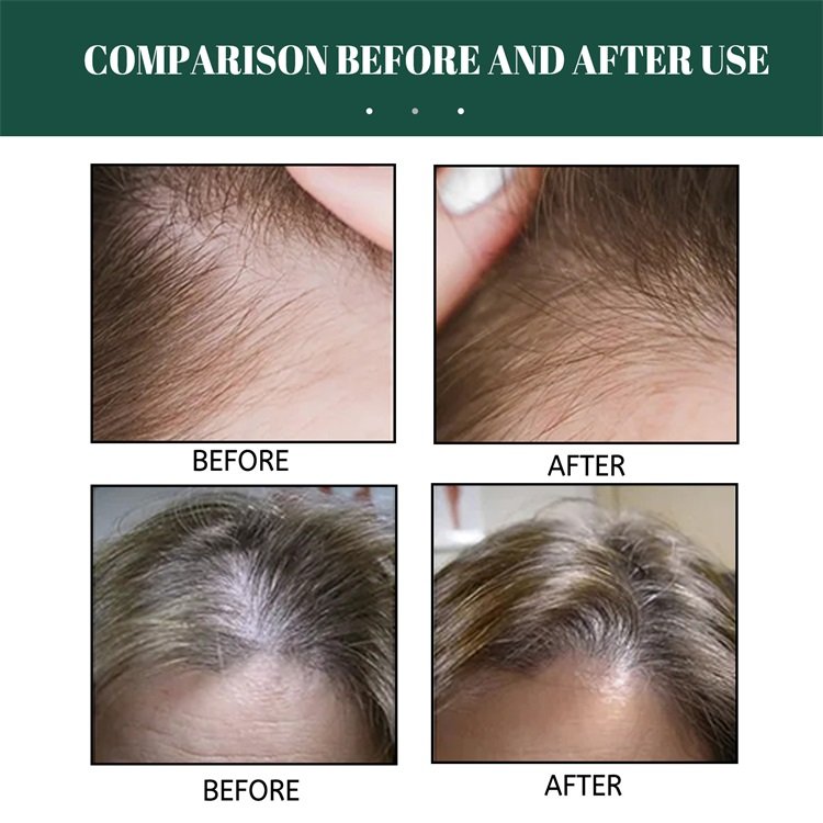 100% natural pure Hair Regrowth Treatment Anti Loss ginger Serum hair growth essence spray