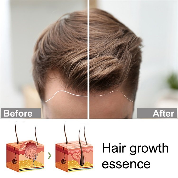 100% natural pure Hair Regrowth Treatment Anti Loss ginger Serum hair growth essence spray