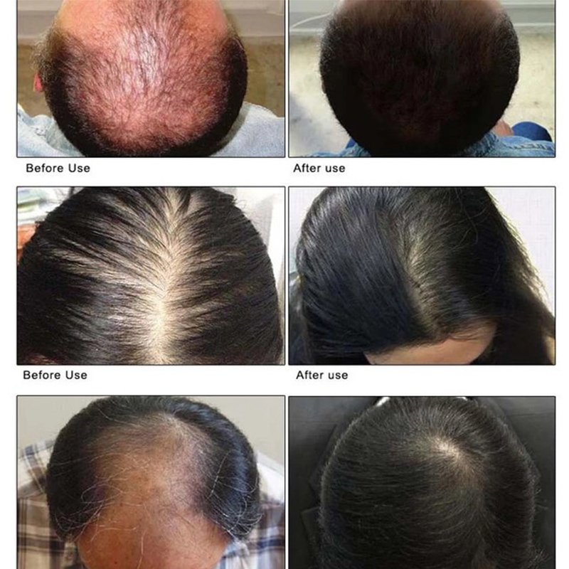 OEM Hair Growth Spray Caffeine Biotin Hair Loss Prevention Serum Stronger Fuller Hair Scalp Nourishing Spray Growth Tonic